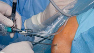 Arthroscopy of knee joint in sports